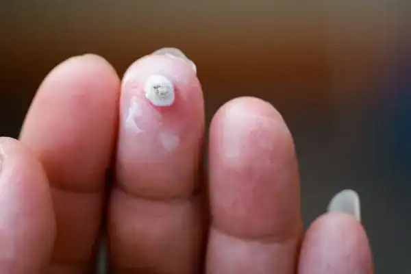 Image of white wart before cryopen treatment Lutterworth