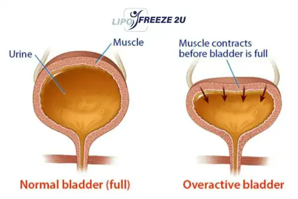 diagram of overactive bladder treatment Lutterworth