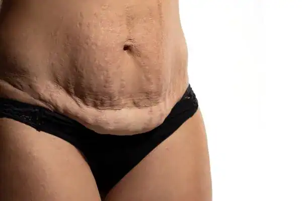 loose skin after weight loss injections Lutterworth