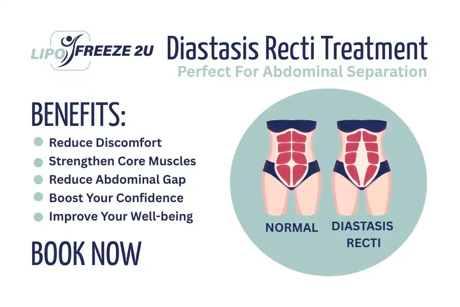 How Long Will It Take to See Improvements in Diastasis Recti Lutterworth