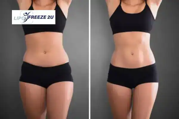 How Can LIPO FREEZE 2U Support Your Post-Pregnancy Body Recovery Lutterworth?