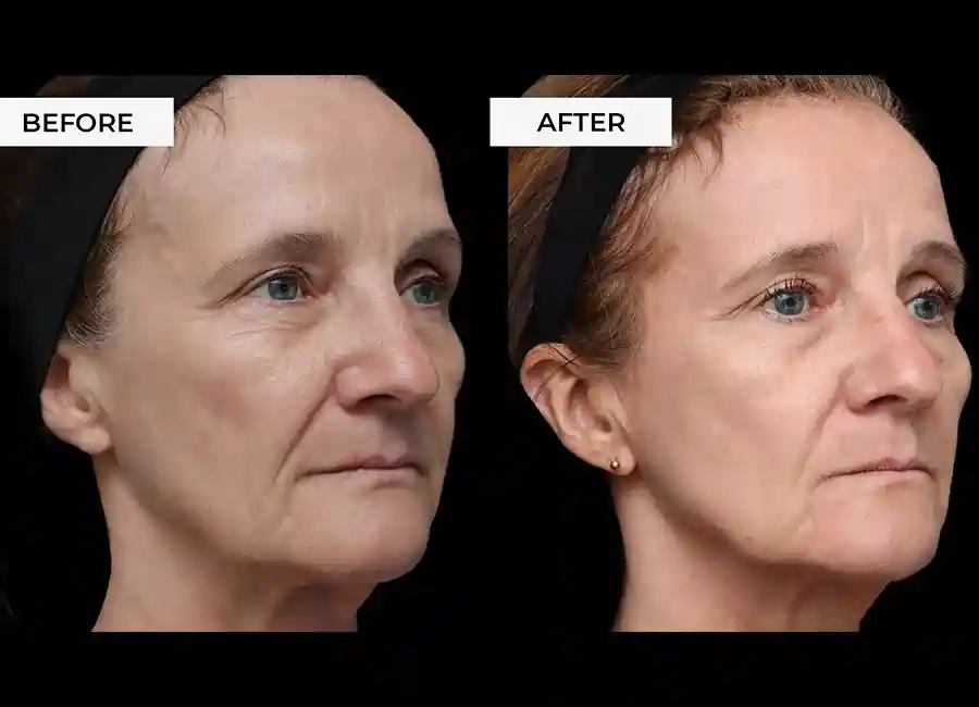 How Many RF Microneedling Sessions Will You Need to See a Difference Lutterworth?