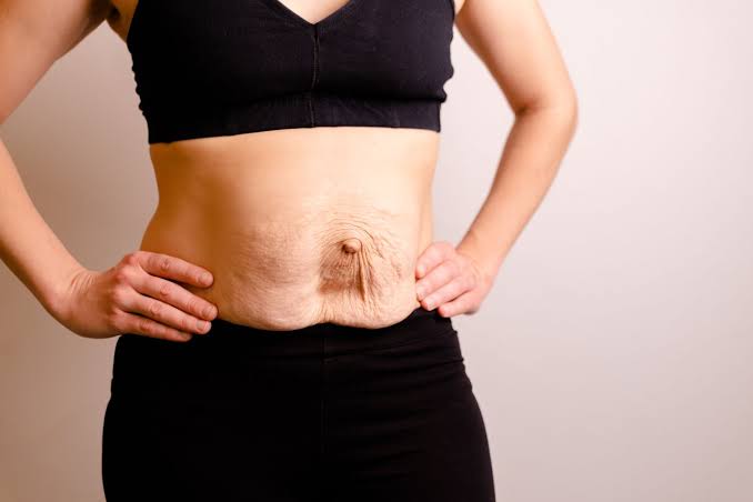 Is Surgery Really the Only Way to Repair Diastasis Recti Lutterworth?