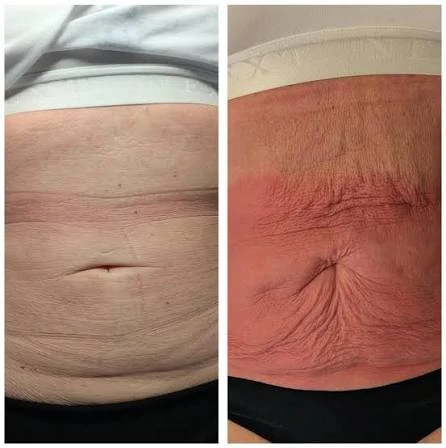 How Does RF Microneedling Improve Crepey, Thin and Uneven Skin Texture Lutterworth?