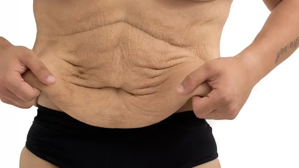 RF Microneedling for Loose Skin: How Can It Help Tighten and Reshape the Skin Lutterworth?